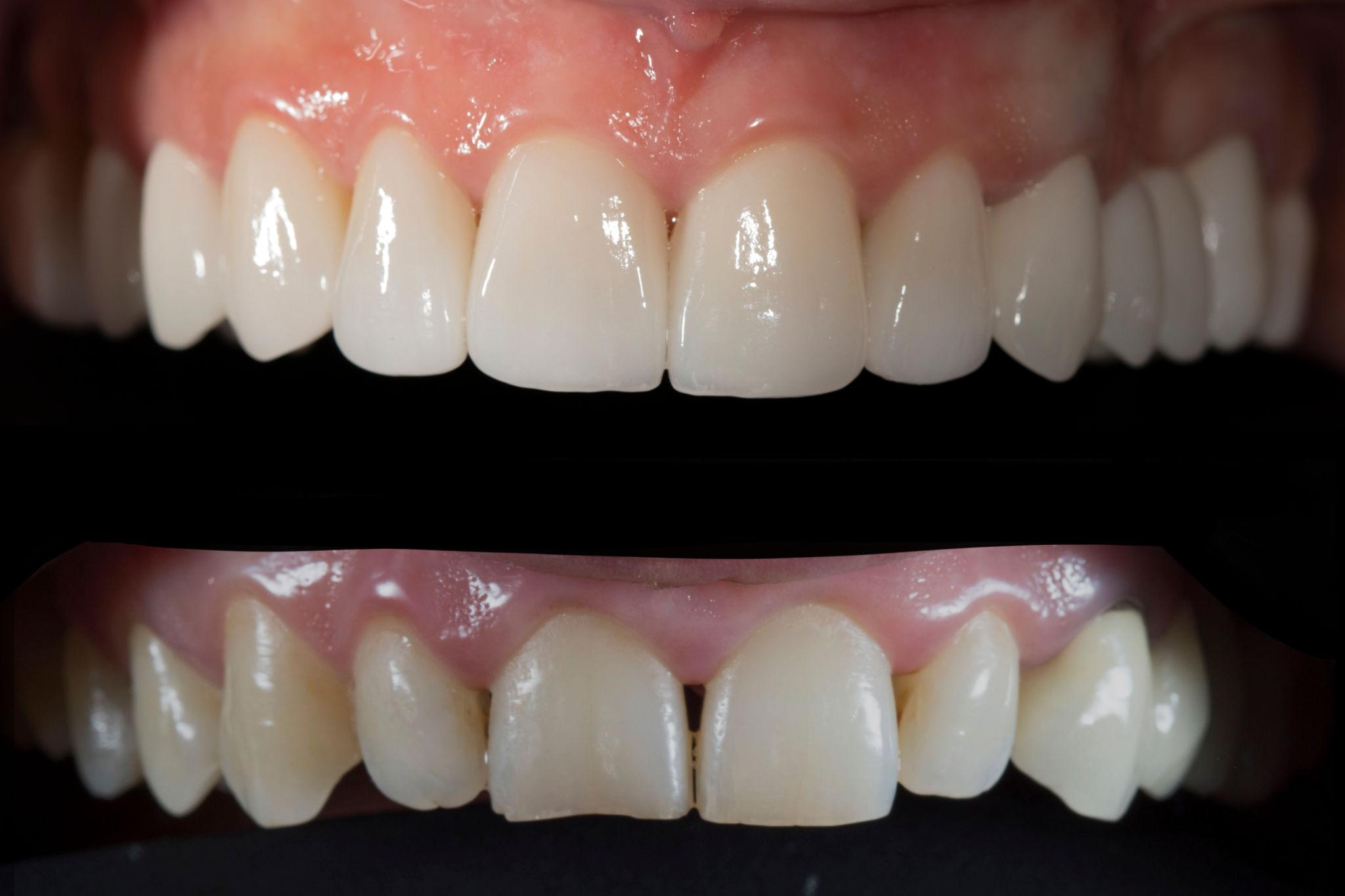 Dental Veneers