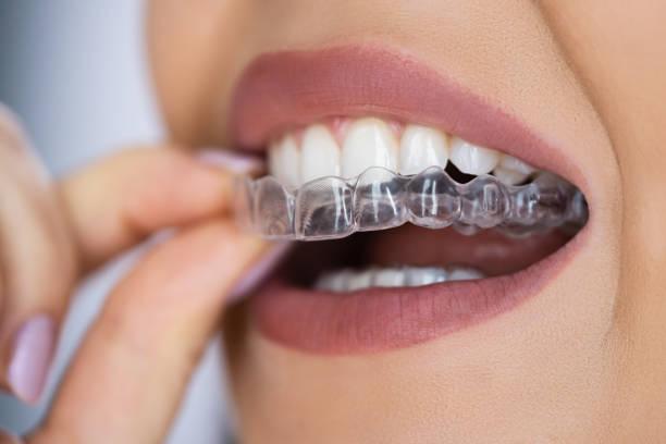 Clear Teeth Aligners